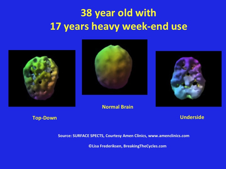 SPECT Scan comparison showing brain changes caused by alcohol misuse. Courtesy: Amen Clinics