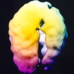 Surface SPECT showing results of traumatic brain injury. The "holes" are not holes but rather areas of low blood flow and therefore low brain metabolism, compromised brain function. SPECT courtesy Amen Clinics, Inc. www.amenclinics.com