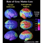 Healthy Brain comparison to brain of person with schizophrenia. Courtesy: Paul M.Thompson, Ph.D., Laboratory of Neuro Imaging, UCLA, NIMH/UCLA Project.