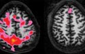 Understanding Brain Effects of Childhood Trauma